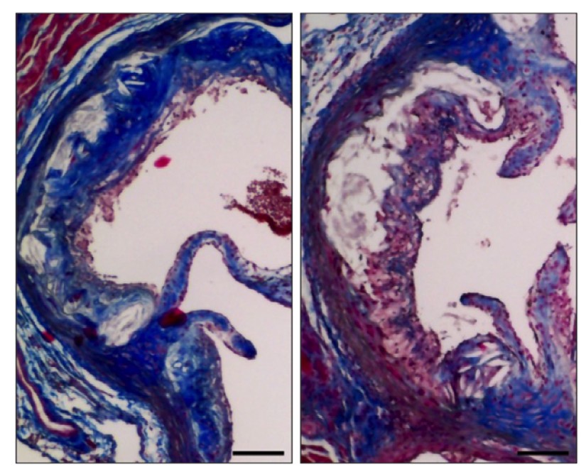 Masson's trichrome histology of atherosclerotic plaques showing collagen (blue) and necrotic core